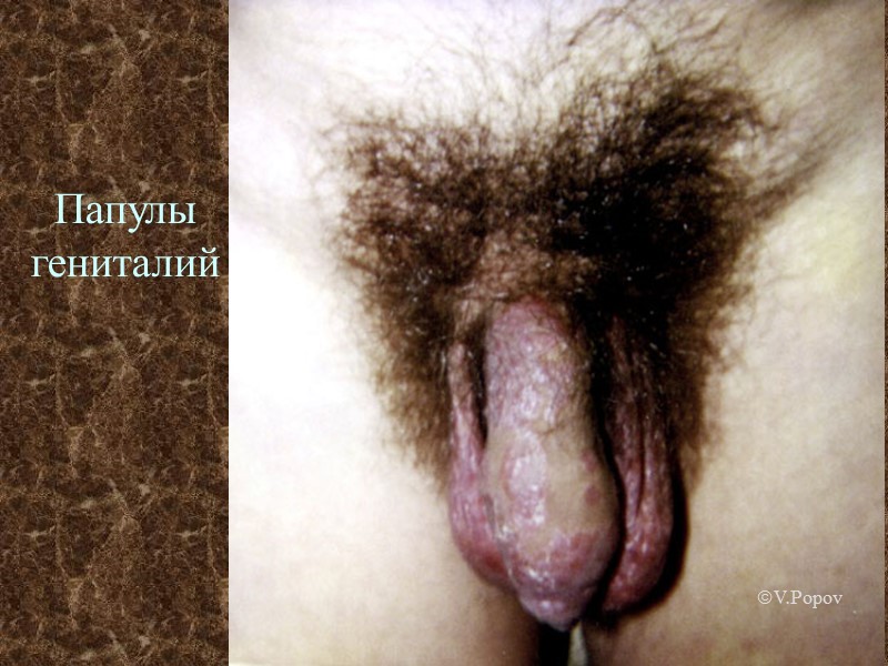 Папулы гениталий г V.Popov